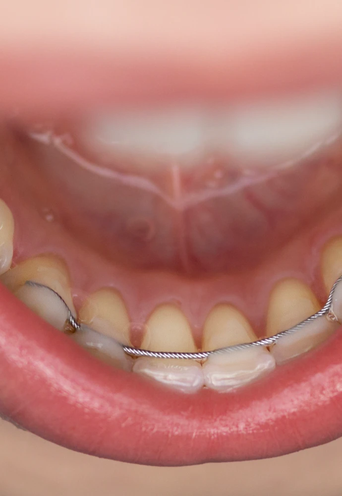 Contention au cabinet du Dr Agathe Chevalier : orthodontie Châteaugiron